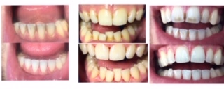 aanslag tanden verwijderen resultaat 