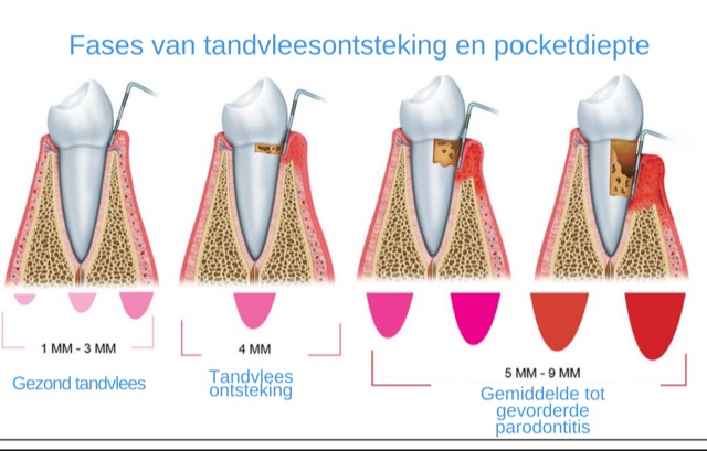 fases van tandvleesontsteking parodontitis gingivitis 