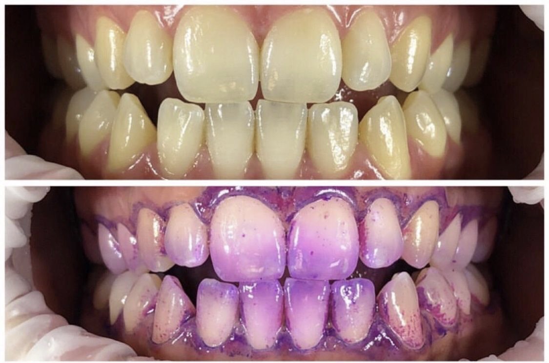 gebit plakkleuring tandplak op tanden 